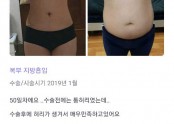 복부지방흡입 50일경과 후기